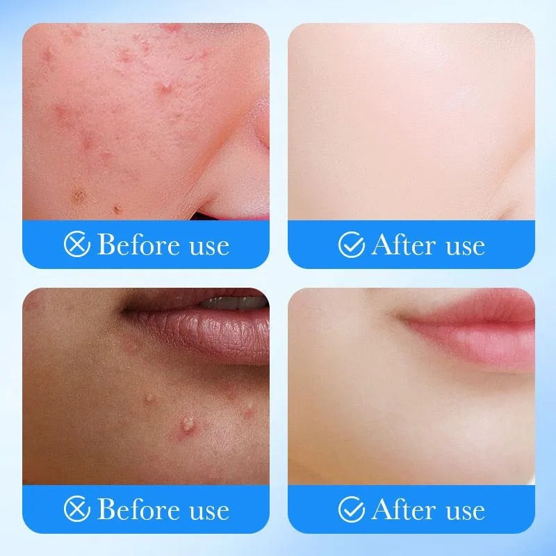 SADORE TAG REMOVER PATCHES